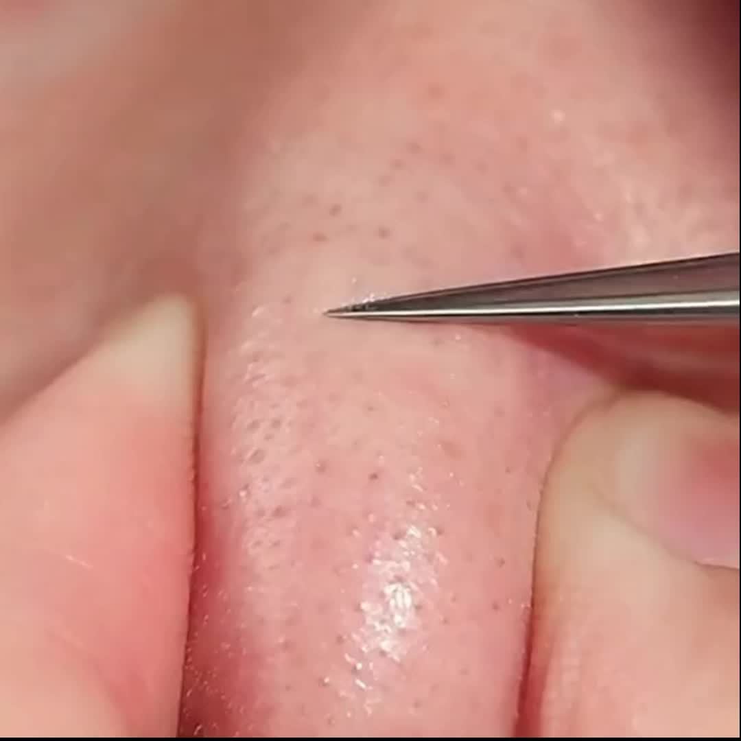 1 Pack Extra Fine No. 5 Blackhead Tweezers - Facial Beauty Remove